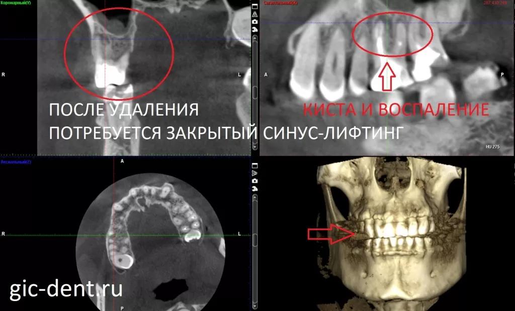 Компьютерная томография позволяет оценить объем кости и спланировать операцию